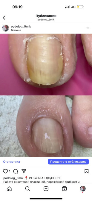 Коррекция вросших ногтей, Услуги подолога, Консультация, Одноразовые расходные материалы Бишкек - изображение 1