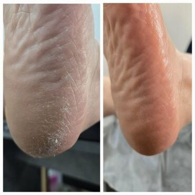 АКЦИЯ, гигиенический педикюр за 1200 сом.! МАНИКЮР ГИГИЕНИЧЕСКИЙ В Бишкек - изображение 3