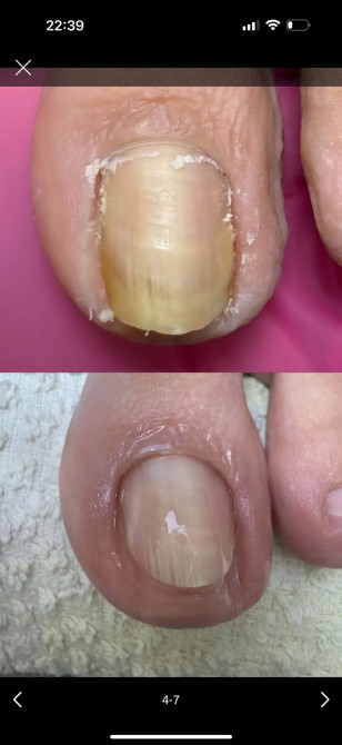 ???? РЕЗУЛЬТАТ ДО/ПОСЛЕ Работа с ногтевой пластиной, поражённой грибком и Бишкек - сүрөт 1