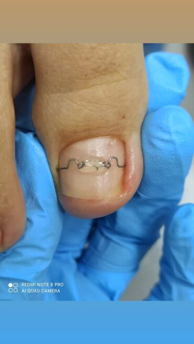 Выравнивание, Наращивание ногтей, Донаращивание ногтей, Маникюр, Педикюр, Услуги подолога, С выездом на дом, Консультация, Одноразовые расходные матер Бишкек - сүрөт 3