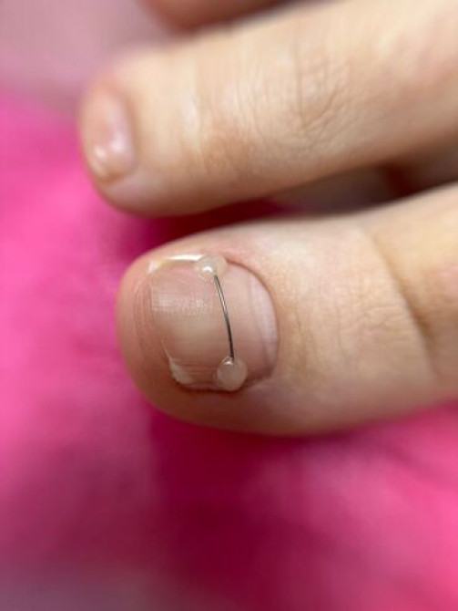 Коррекция вросших ногтей, Педикюр, Консультация, Одноразовые расходные материалы, С выездом на дом Бишкек - изображение 1