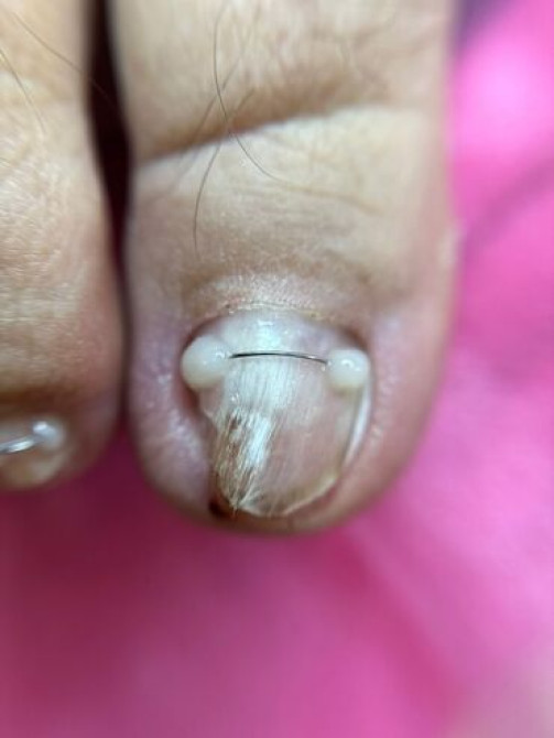 Коррекция вросших ногтей, Педикюр, Консультация, Одноразовые расходные материалы, С выездом на дом Бишкек - изображение 2