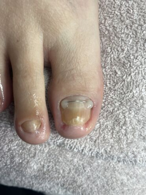 Коррекция вросших ногтей, Педикюр, Консультация, Одноразовые расходные материалы, С выездом на дом Бишкек - изображение 5