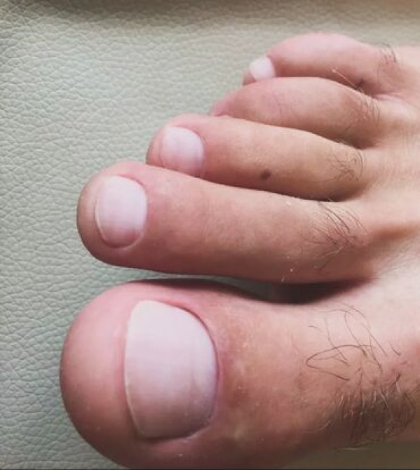 Коррекция вросших ногтей, Педикюр, Консультация, Одноразовые расходные материалы, С выездом на дом Бишкек - изображение 4