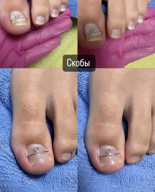 Выравнивание, Услуги подолога, Консультация, Одноразовые расходные материалы Бишкек - изображение 1