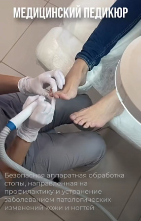 Коррекция вросших ногтей, Маникюр, Педикюр, Услуги подолога, Консультация, Одноразовые расходные материалы Бишкек - изображение 1