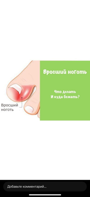 Коррекция вросших ногтей, Услуги подолога, Консультация, Одноразовые расходные материалы Бишкек - изображение 1